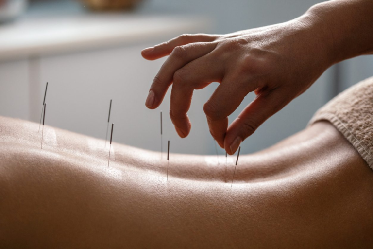 ACUPUNCTURE