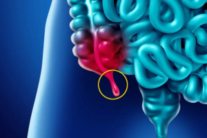 APPENDIX CANCER