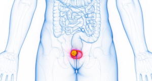 BLADDER CANCER