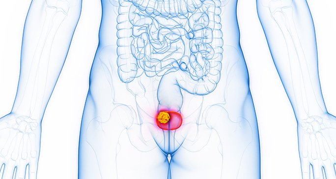 BLADDER CANCER