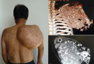 BONE CANCER (BONE SARCOMA)