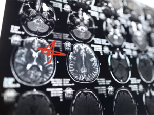 BRAIN CANCER