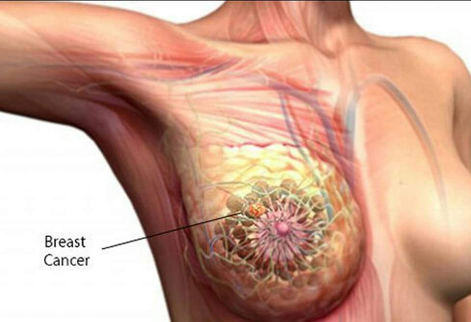 BREAST CANCER