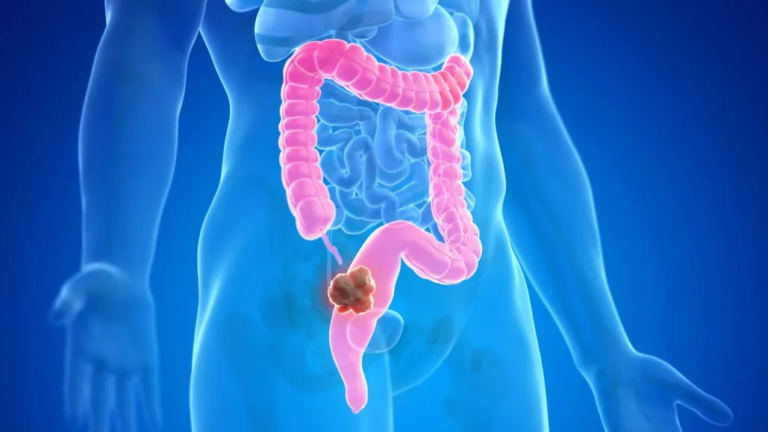 COLON OR COLORECTAL CANCER