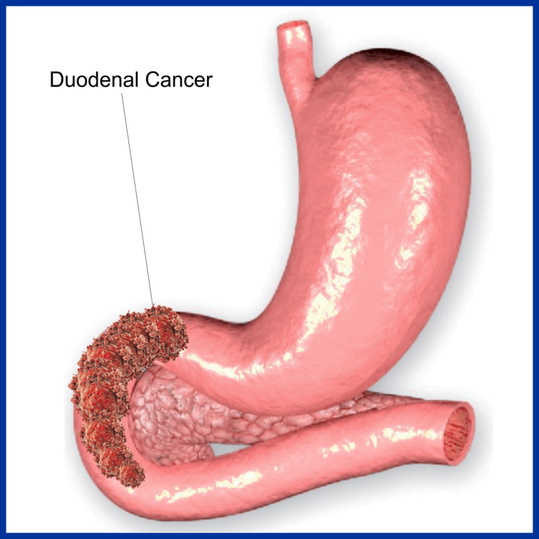 DUODENAL CANCER