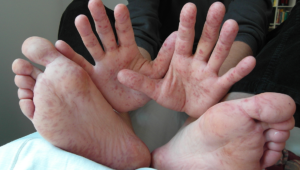 HAND, FOOT, AND MOUTH DISEASE
