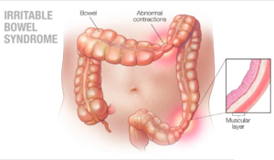 IRRITABLE BOWEL SYNDROME (IBS)
