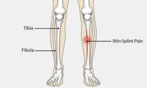 SHIN SPLINT