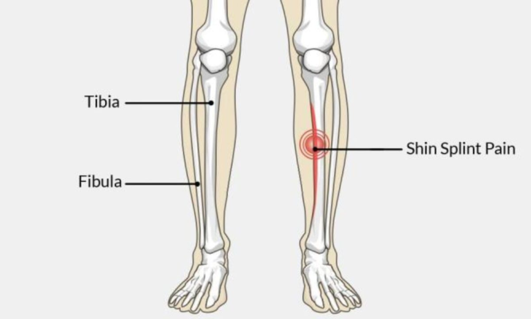 SHIN SPLINT