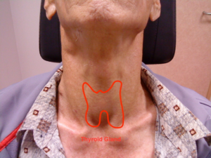 THYROID CANCER