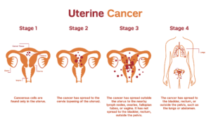UTERINE CANCER