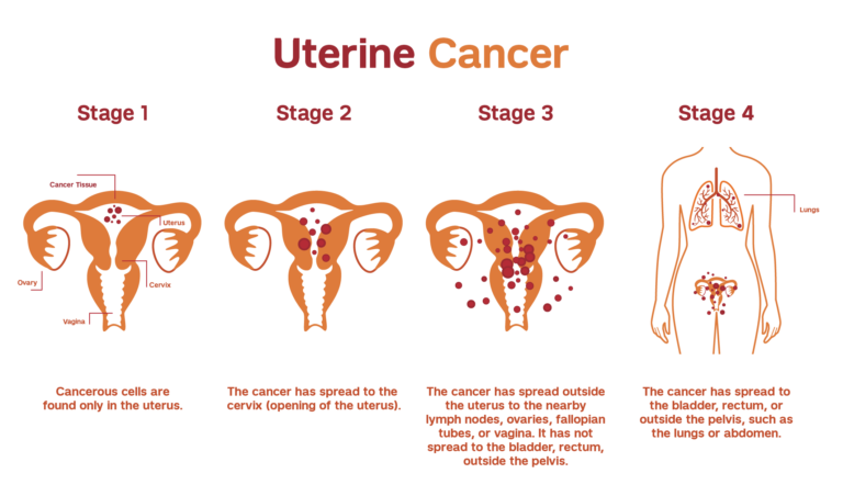 UTERINE CANCER