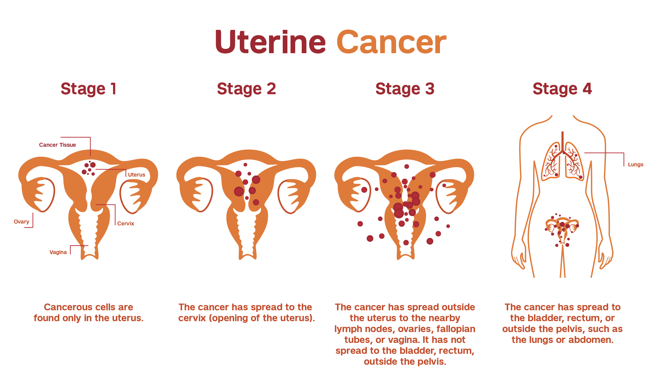 UTERINE CANCER