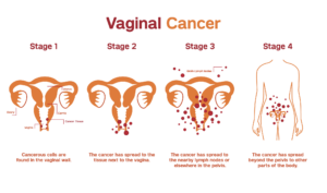 VAGINAL CANCER