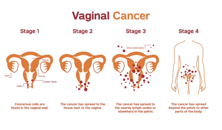 VAGINAL CANCER