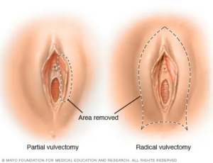 VULVAR CANCER
