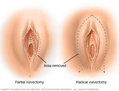 VULVAR CANCER