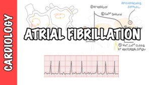 ATRIAL FIBRILLATION