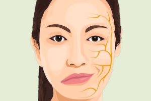 BELL'S PALSY