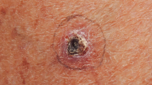 CARCINOMA