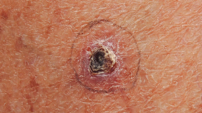 CARCINOMA