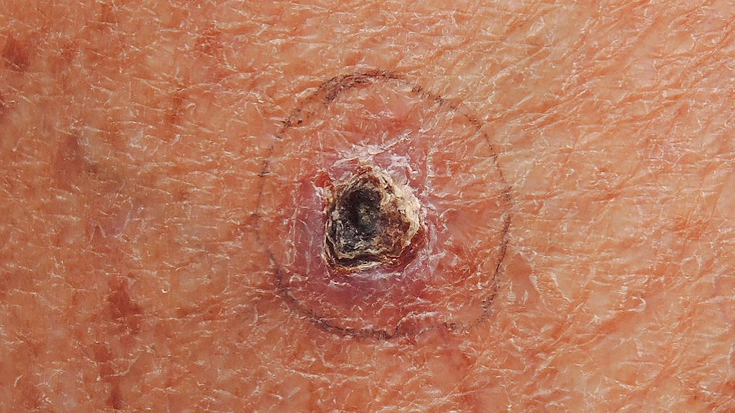 CARCINOMA