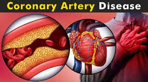 CORONARY ARTERY DISEASE