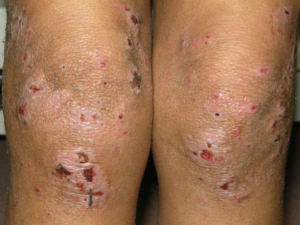 ECZEMA