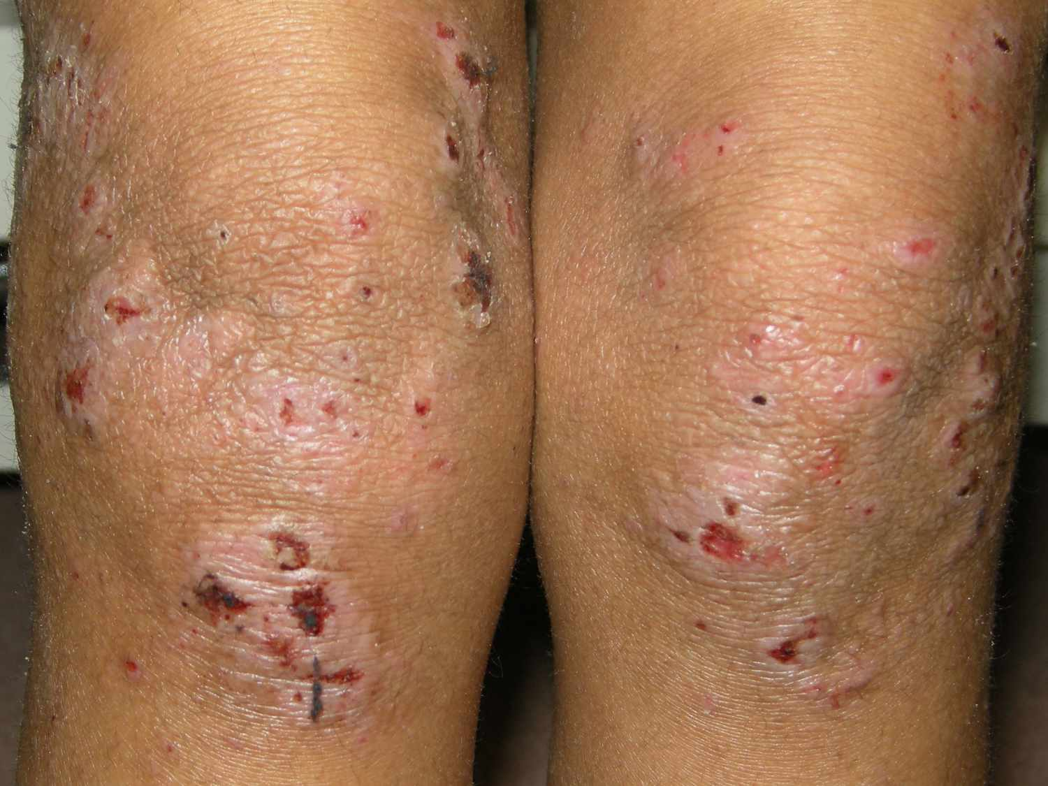 ECZEMA
