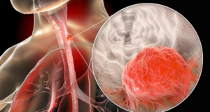 ESOPHAGEAL CANCER