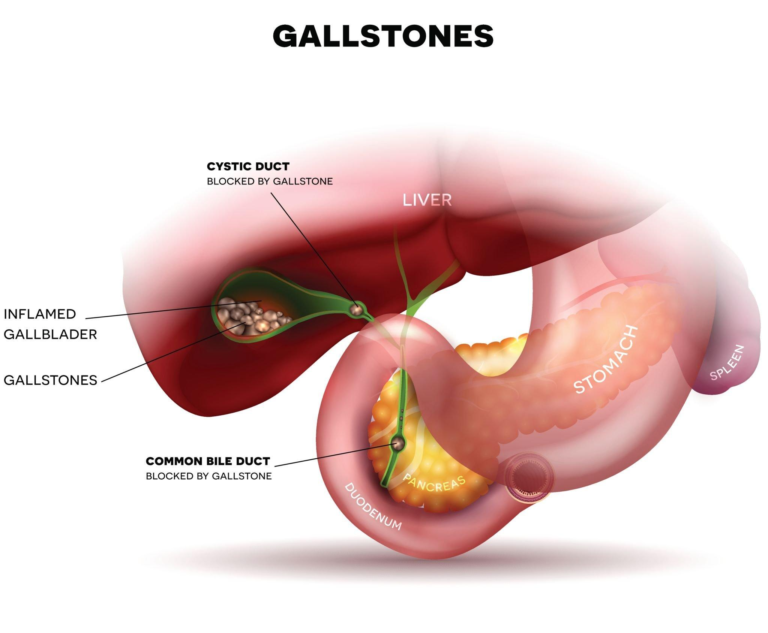 GALLBLADDER CANCER