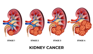 KIDNEY CANCER