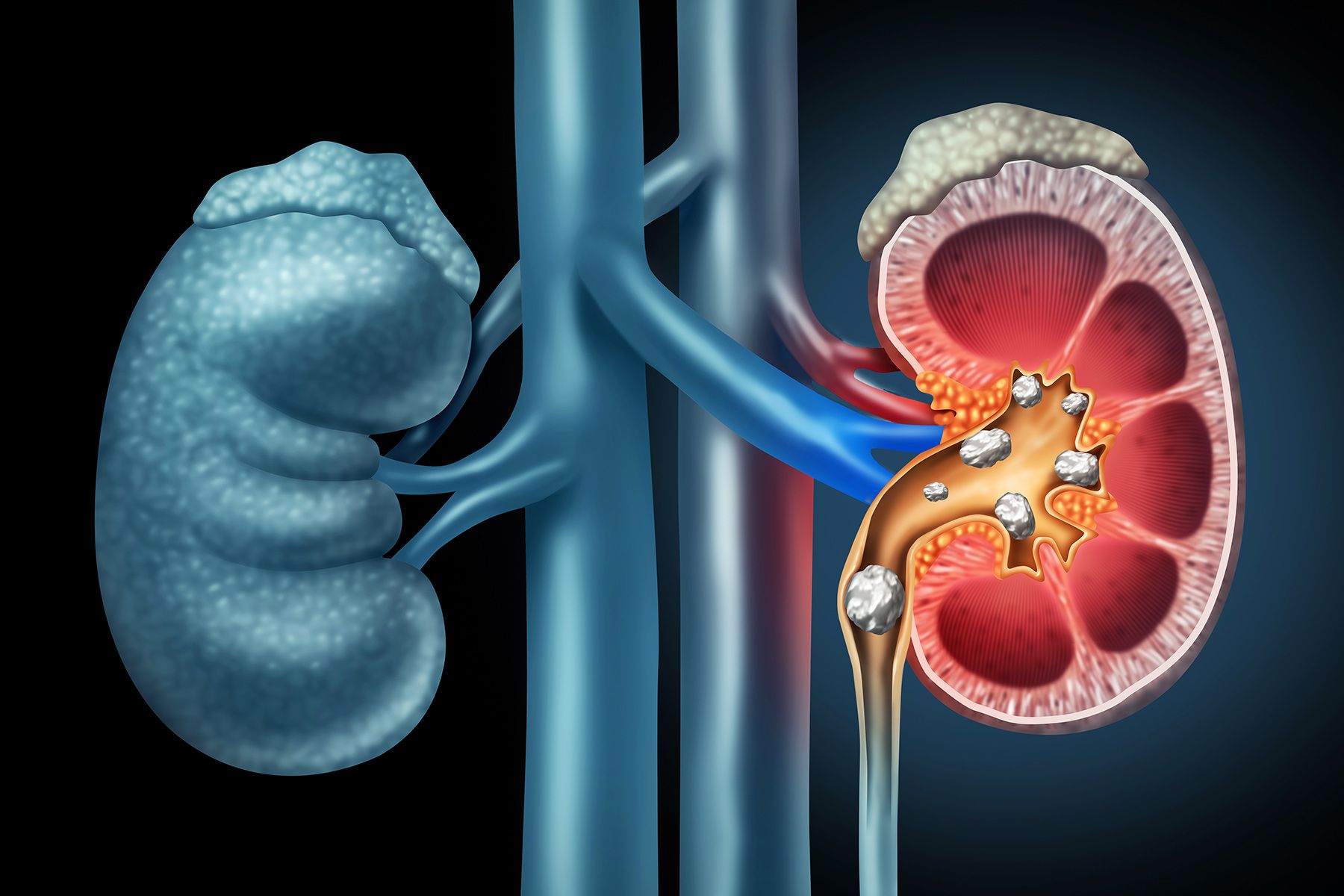 KIDNEY STONE