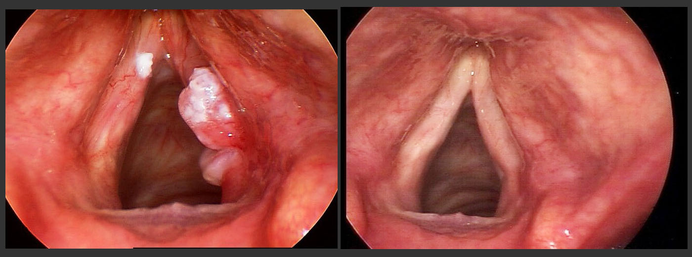 LARYNGEAL CANCER