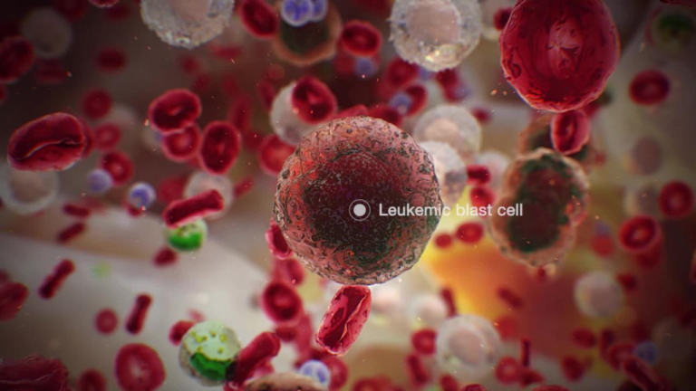 LEUKEMIA