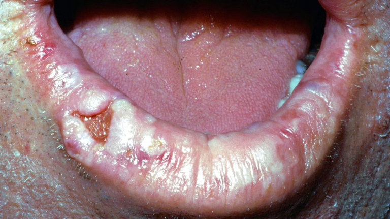 LIP CANCER