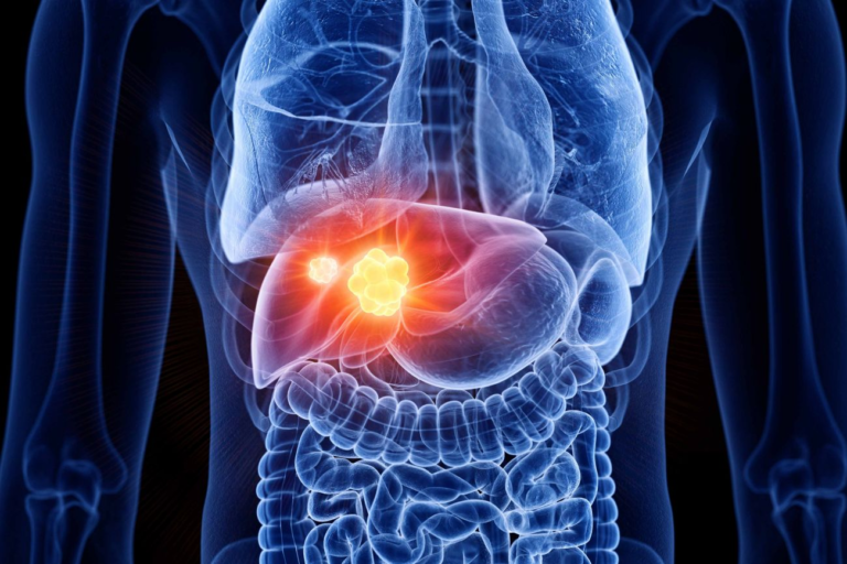 LIVER CANCER