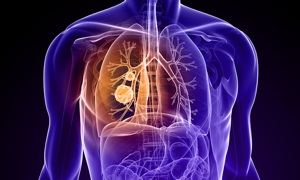LUNG CANCER