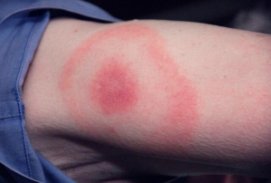 LYME DISEASE