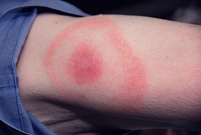 LYME DISEASE