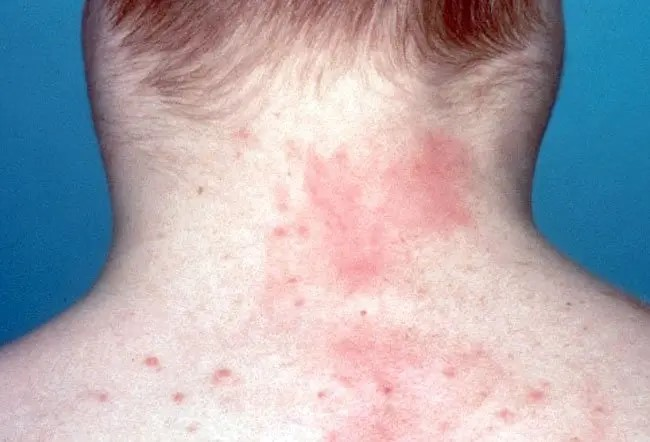 LYMPHOMA