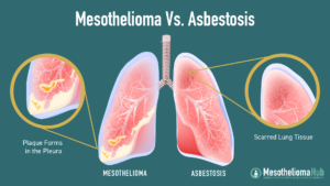 MESOTHELIOMA