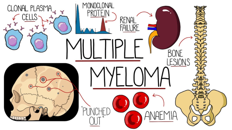 MULTIPLE MYELOMA