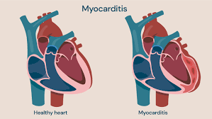 MYOCARDITIS