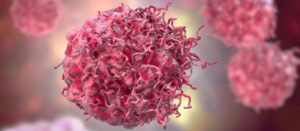 Neoplasm