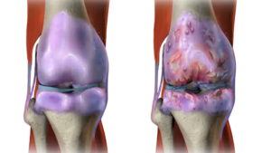 OSTEOARTHRITIS