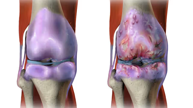 OSTEOARTHRITIS