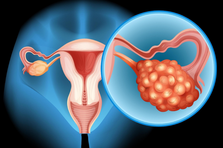 OVARIAN CANCER