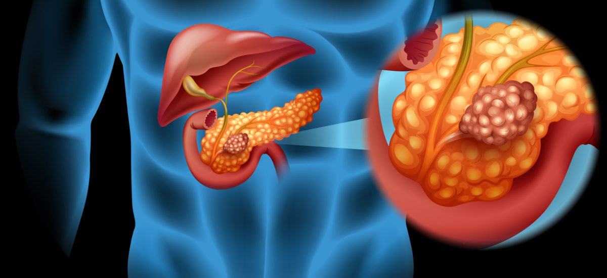 PANCREATIC CANCER
