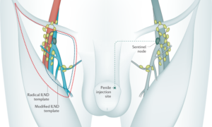 PENILE CANCER